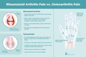 Osteoarthritis Pain vs. Rheumatoid Arthritis Pain
