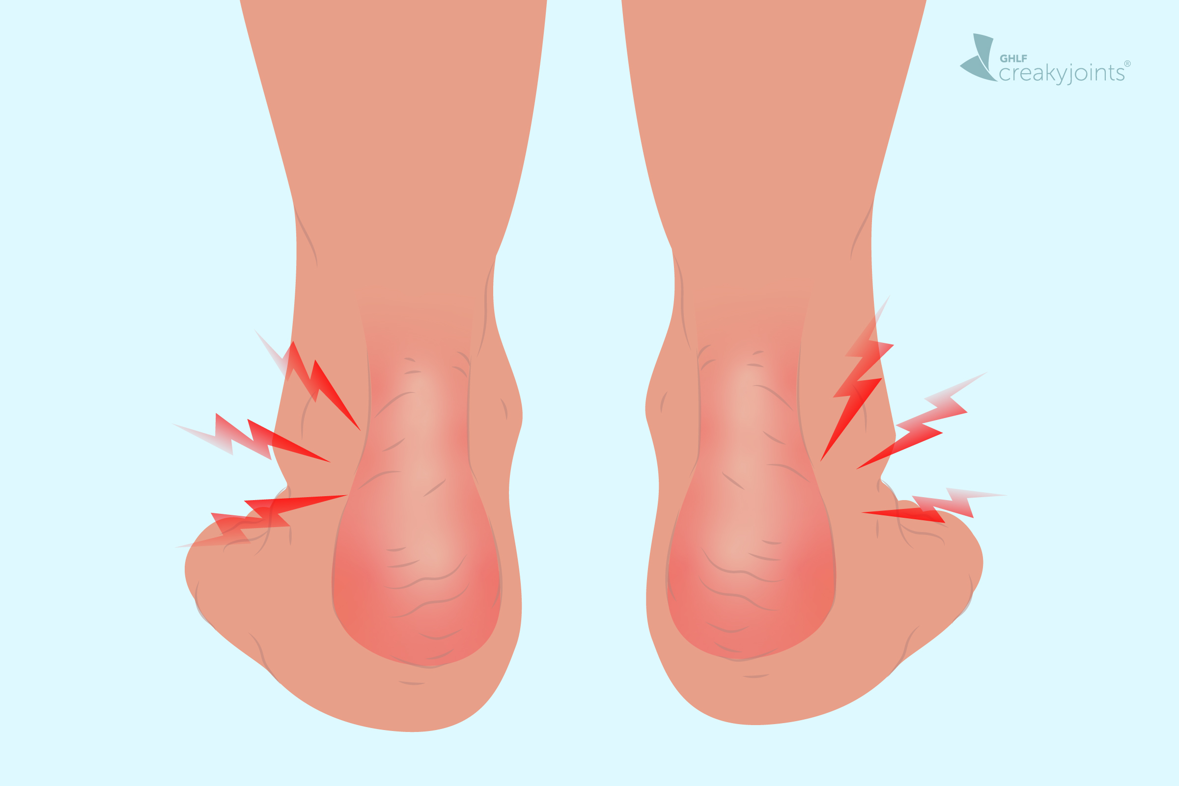 psoriasis on feet burning sensation)