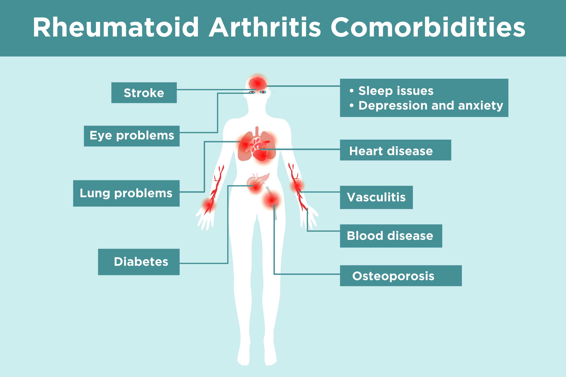 Rheumatoid Arthritis Complications What Ra Patients Need To Know 1703