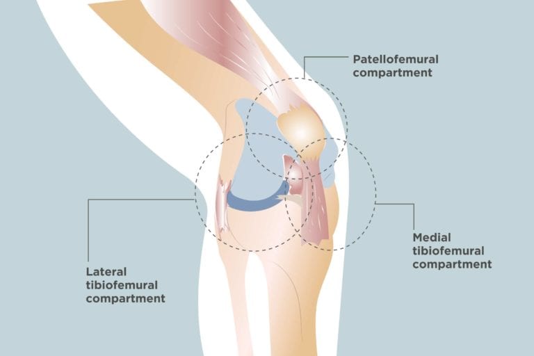 Tricompartmental Osteoarthritis Symptoms Diagnosis Treatment