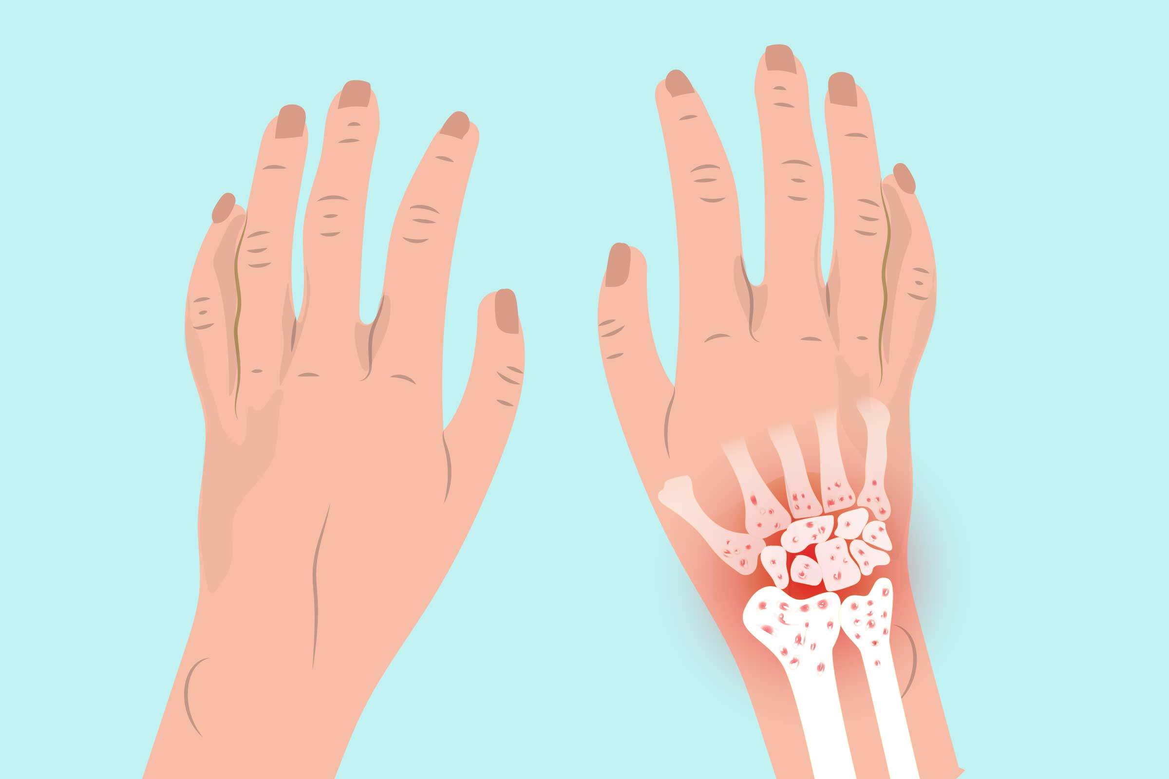 Arthritis in the Wrist Symptoms, Types of Wrist Arthritis, Treatments