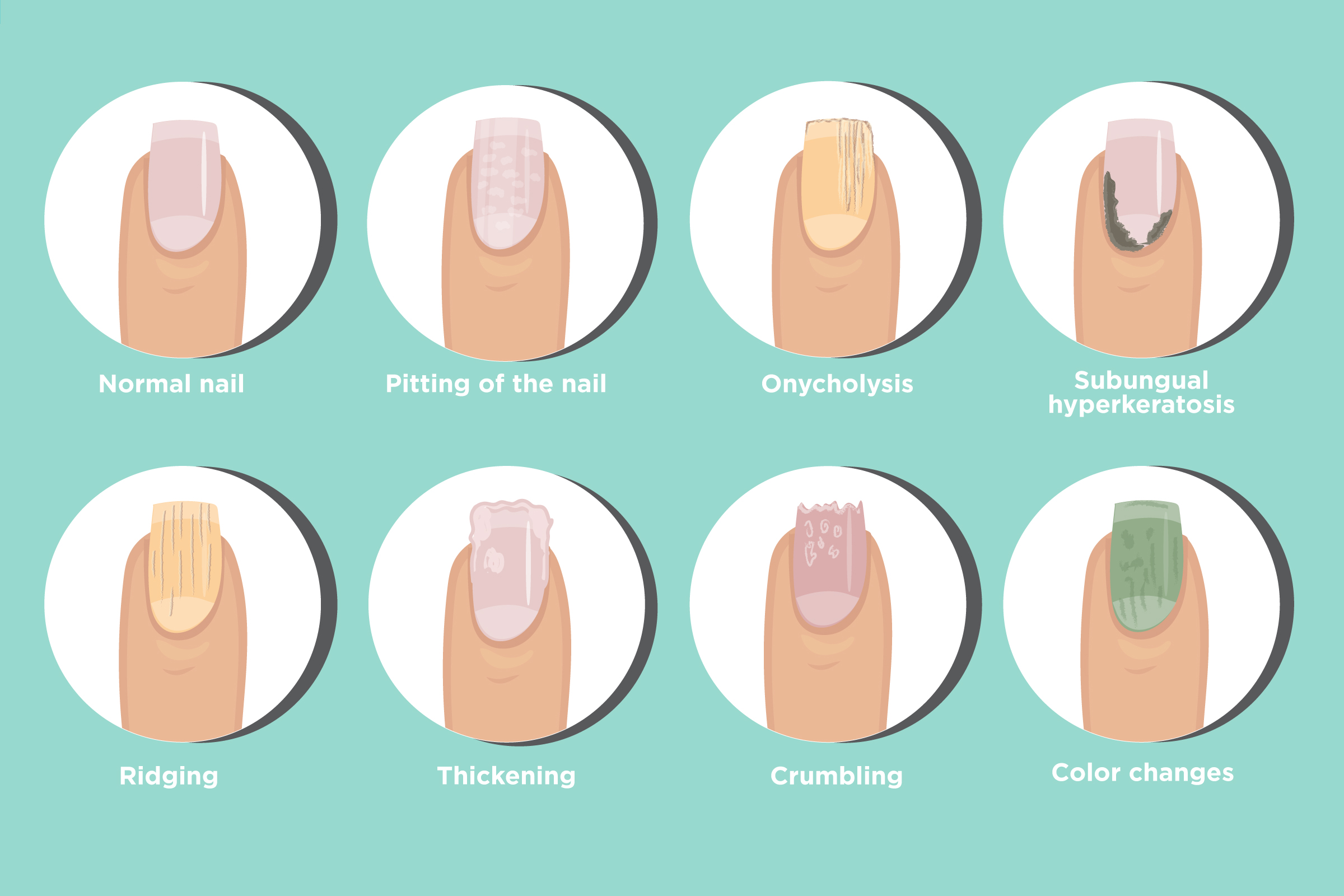 3. How to Tell if Your Nail Color is a Sign of Health Problems - wide 9
