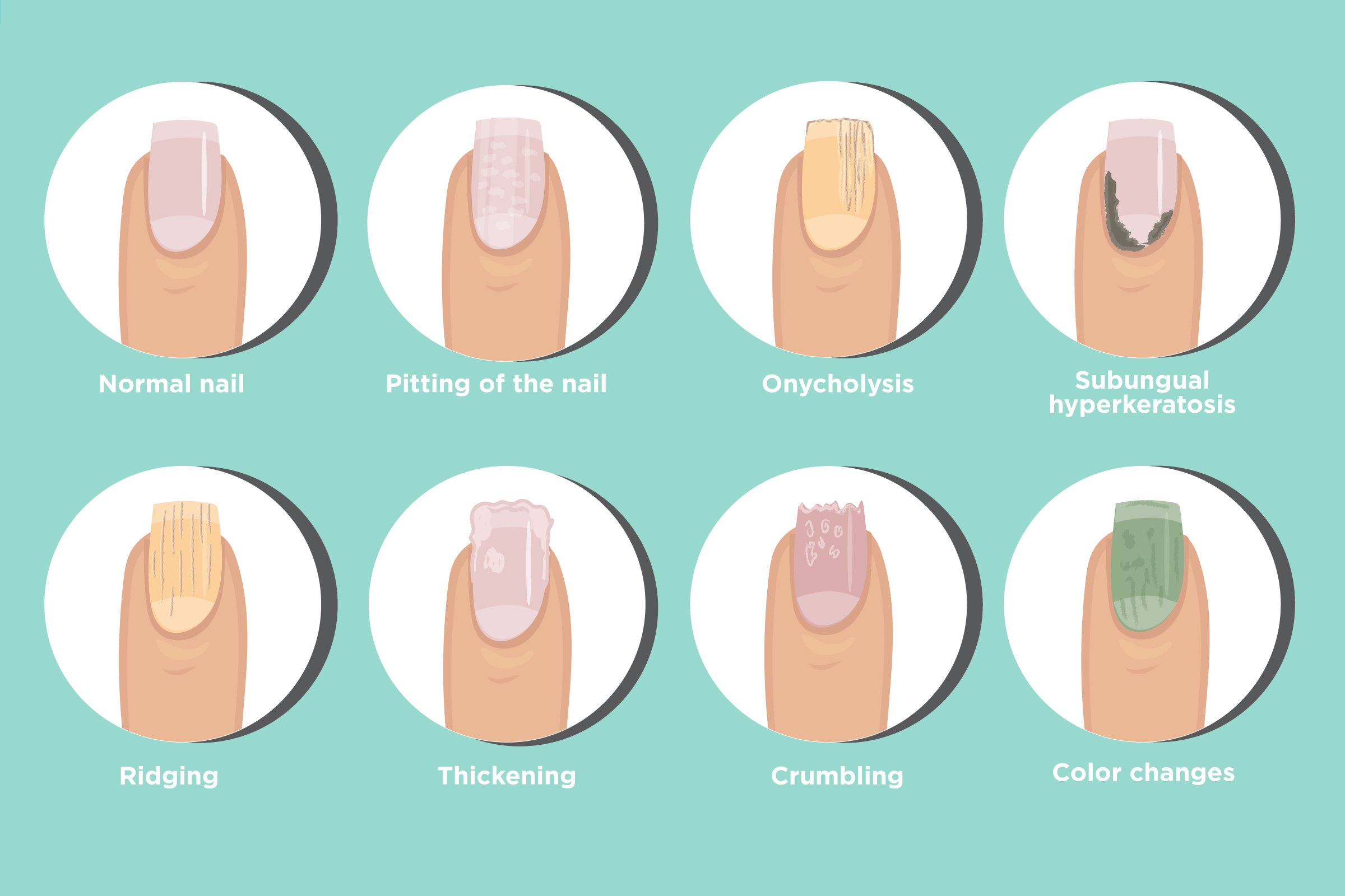 Medical Conditions That Can Affect Nail Bed Color - wide 10