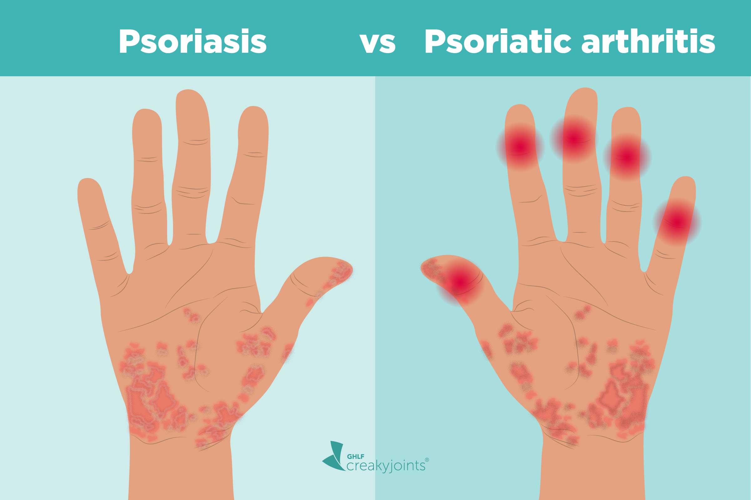 Psoriasis And Psoriatic Arthritis Whats The Connection