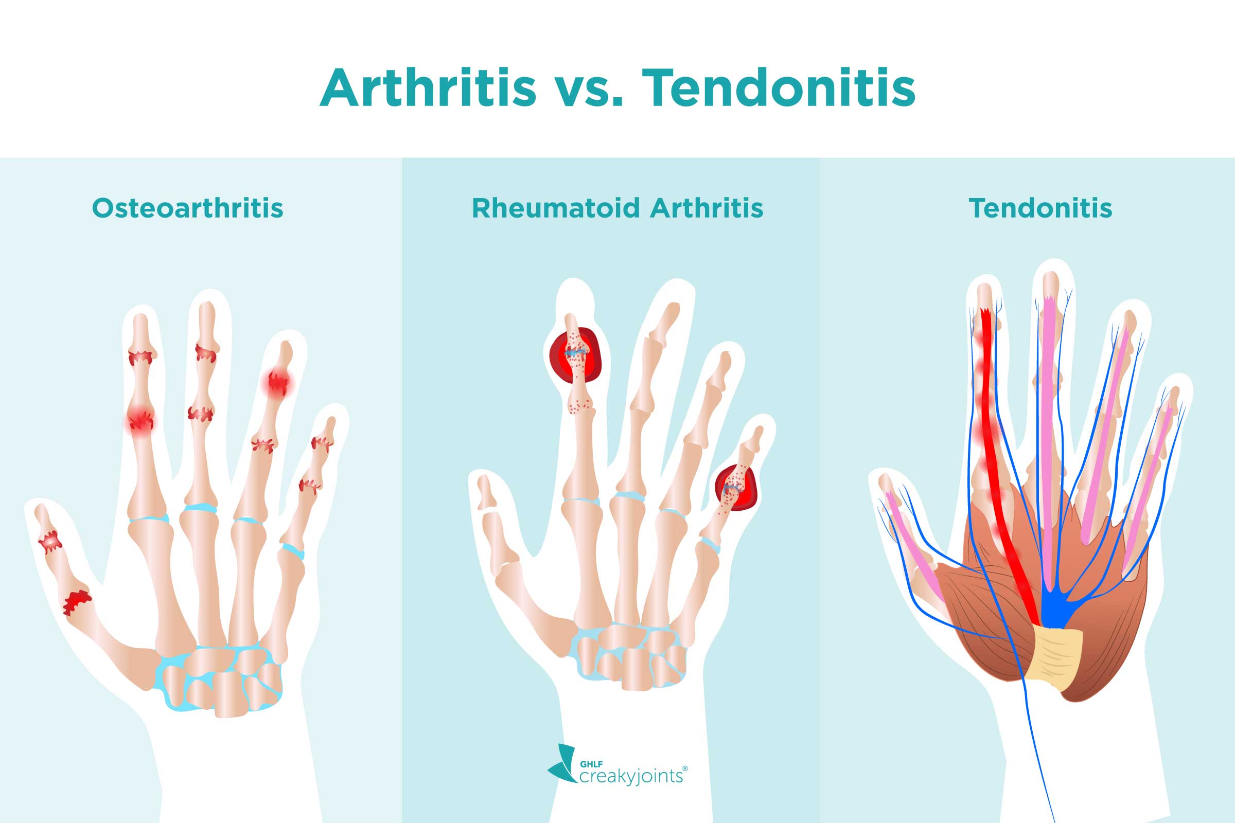 what-s-the-difference-between-arthritis-and-tendonitis