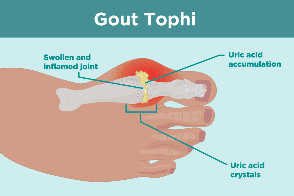 tophi gout