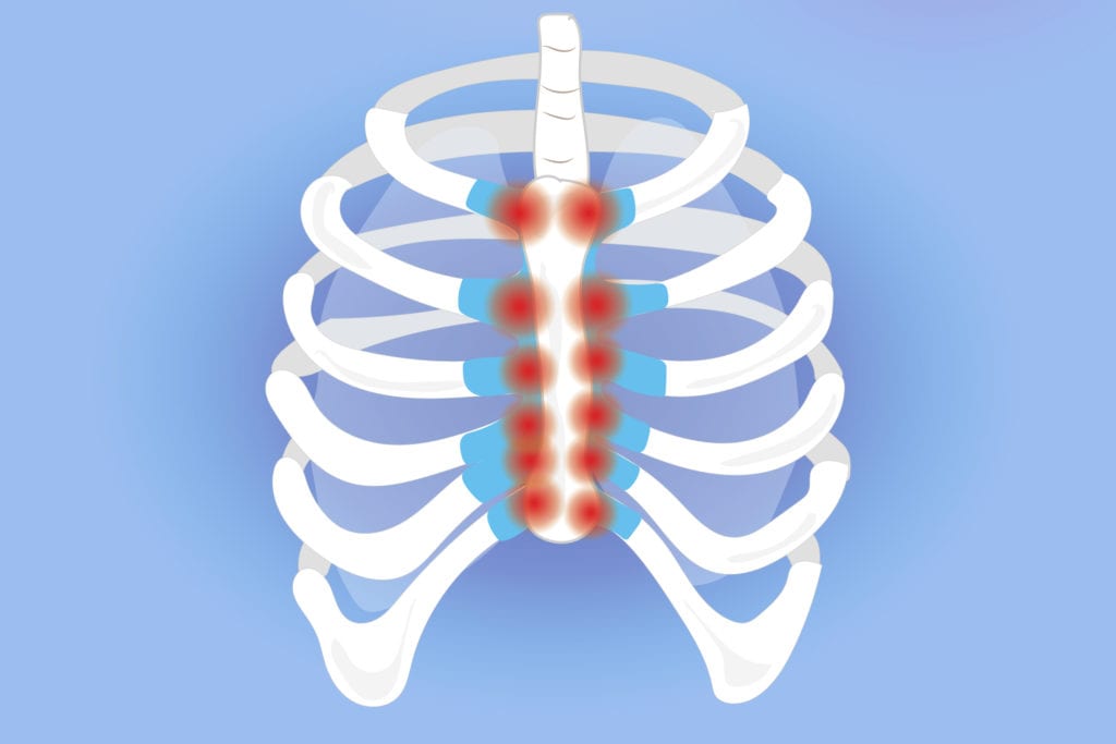 Costochondritis jest przyczyną przeszywającego bólu brzucha podczas kaszlu.