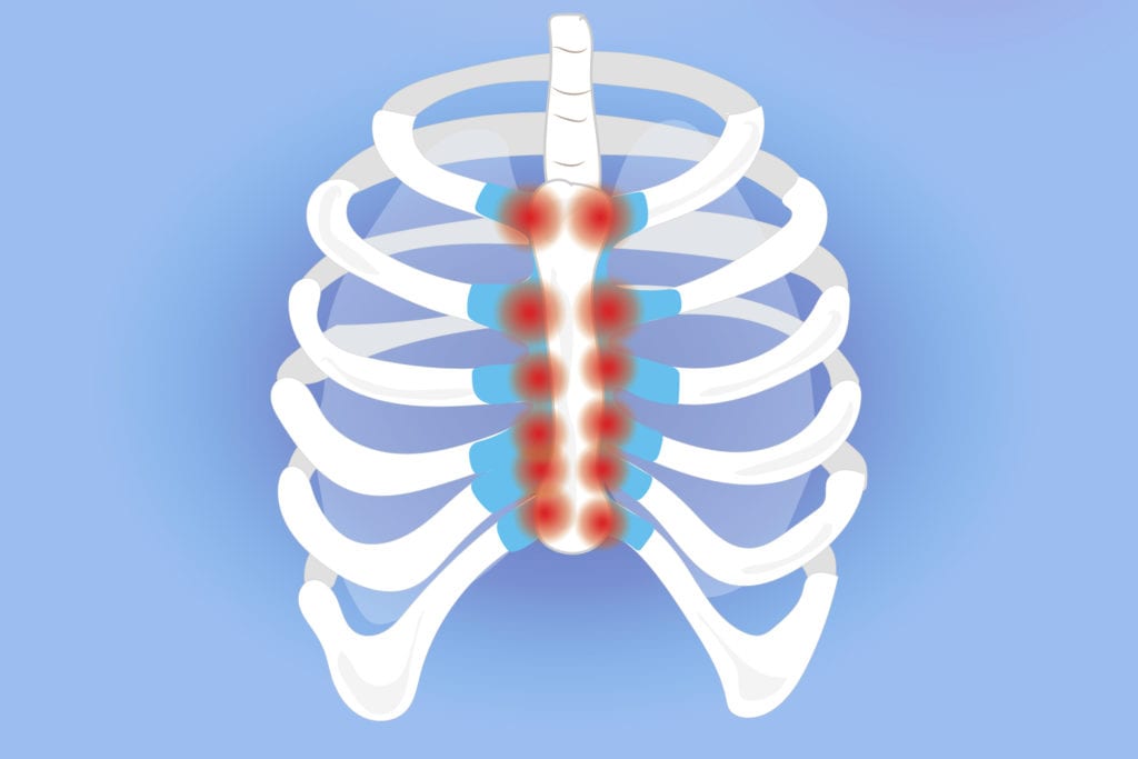 Costochondritis เป็นสาเหตุของอาการปวดเสียดท้องเมื่อไอ