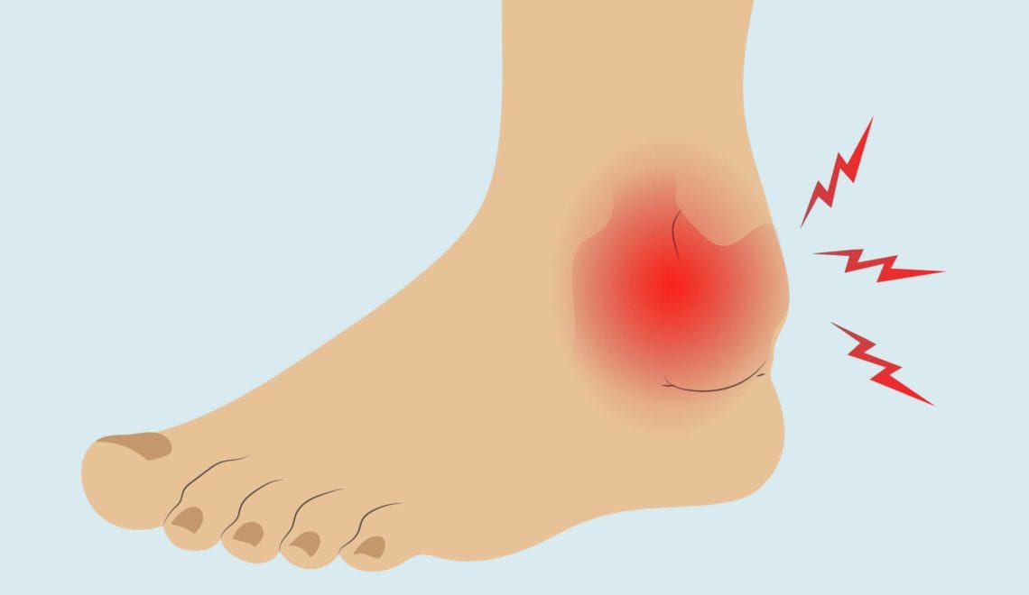 Arthritis in Ankle