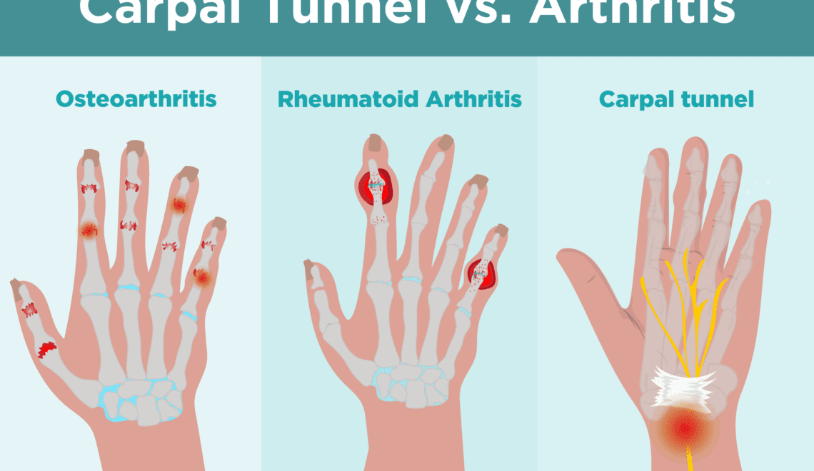 Carpal Tunnel vs. Arthritis