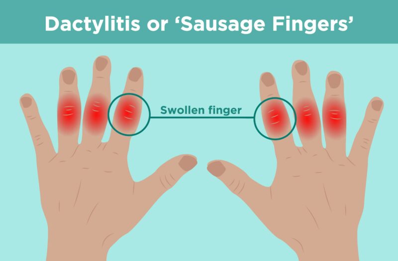 Image reads Dactylitis or 'Sausage Fingers" the image shows fingers with swollen joints