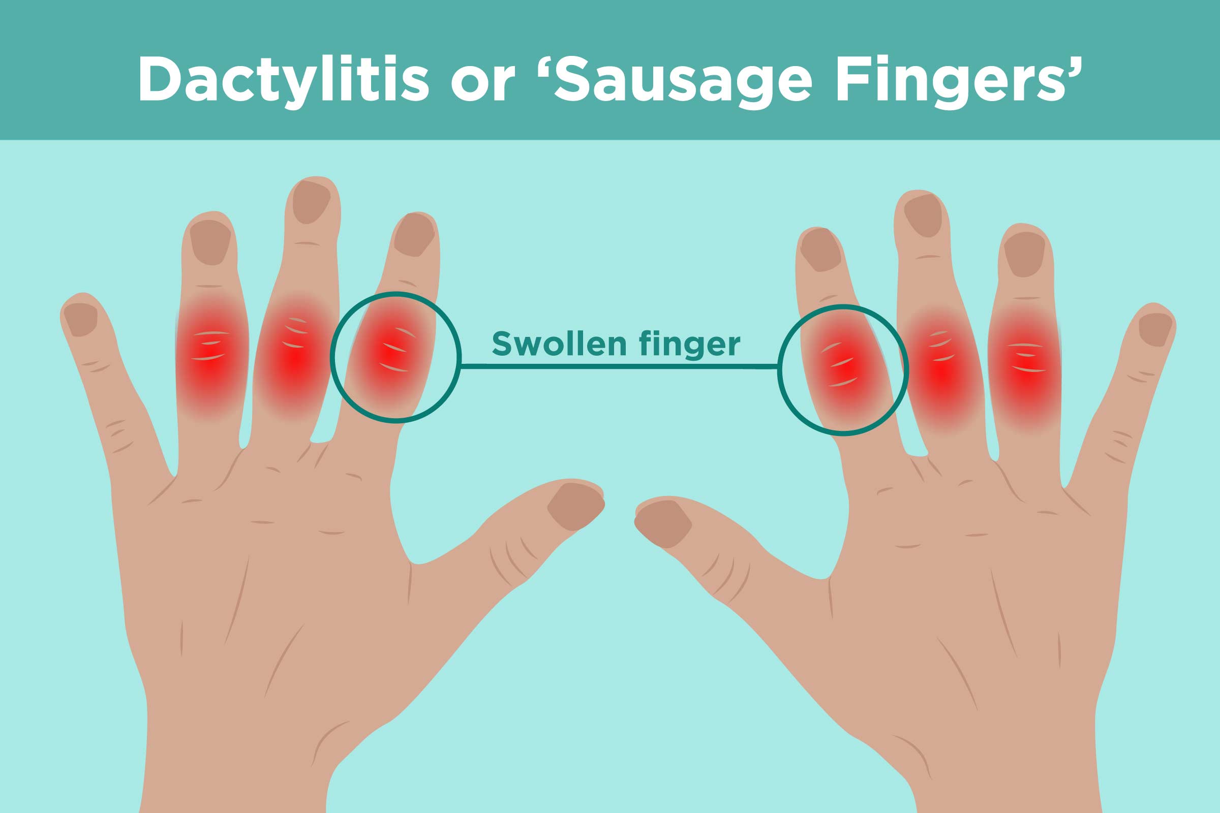 Learn more about dactylitis, or inflammation of the fingers and toes that i...
