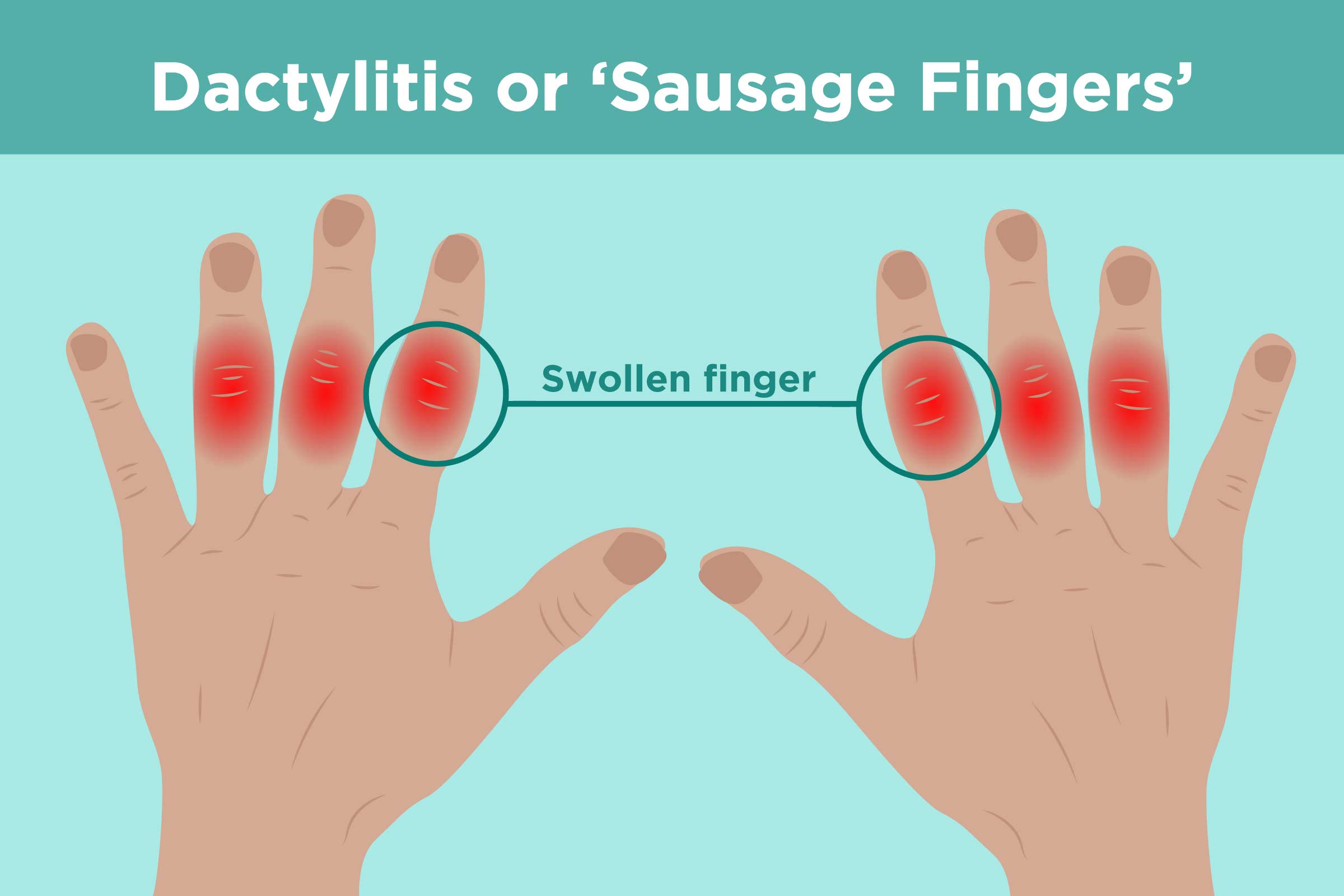 what is arthritis like in fingers