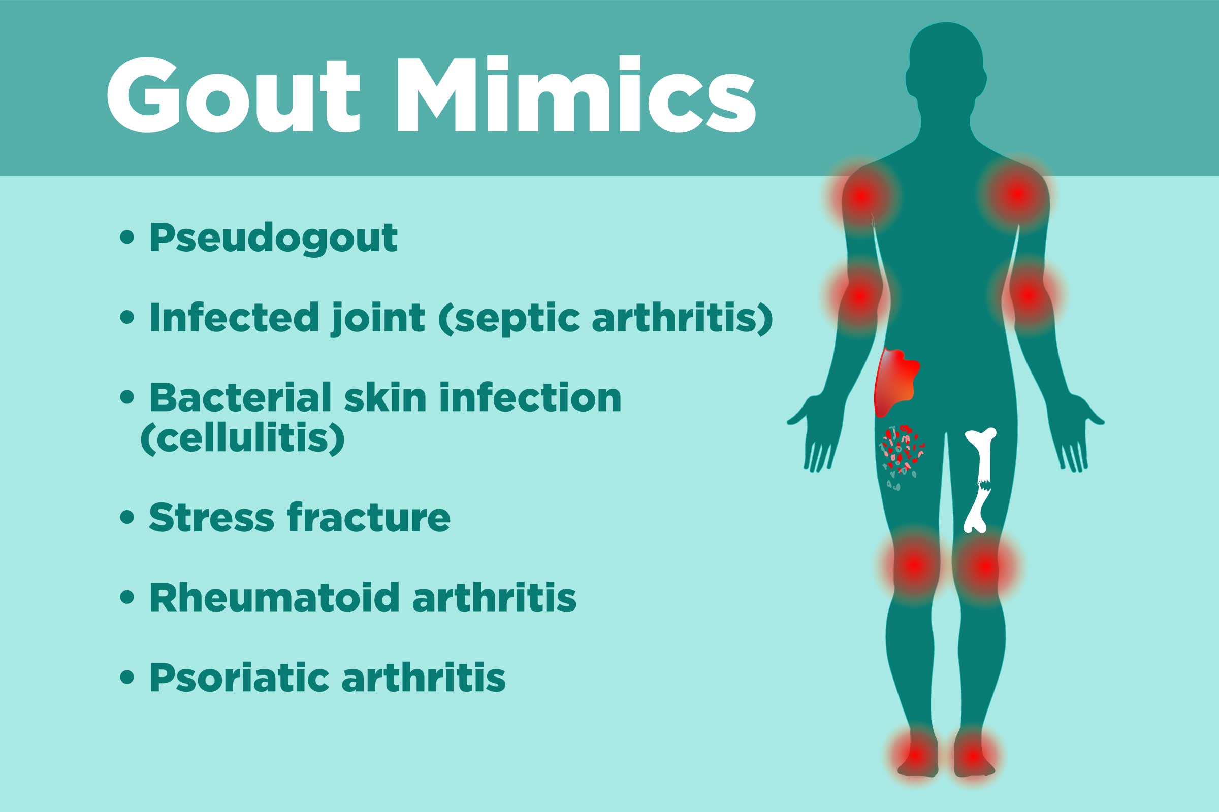 Gout Misdiagnosis Diseases Gout Can Be Mistaken For