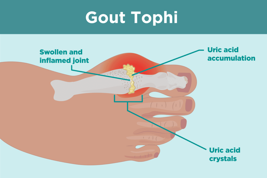 pathophysiology-gout