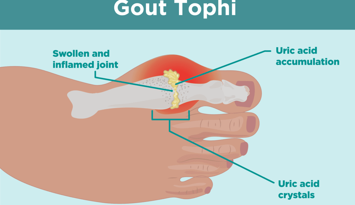 Gout Tophi