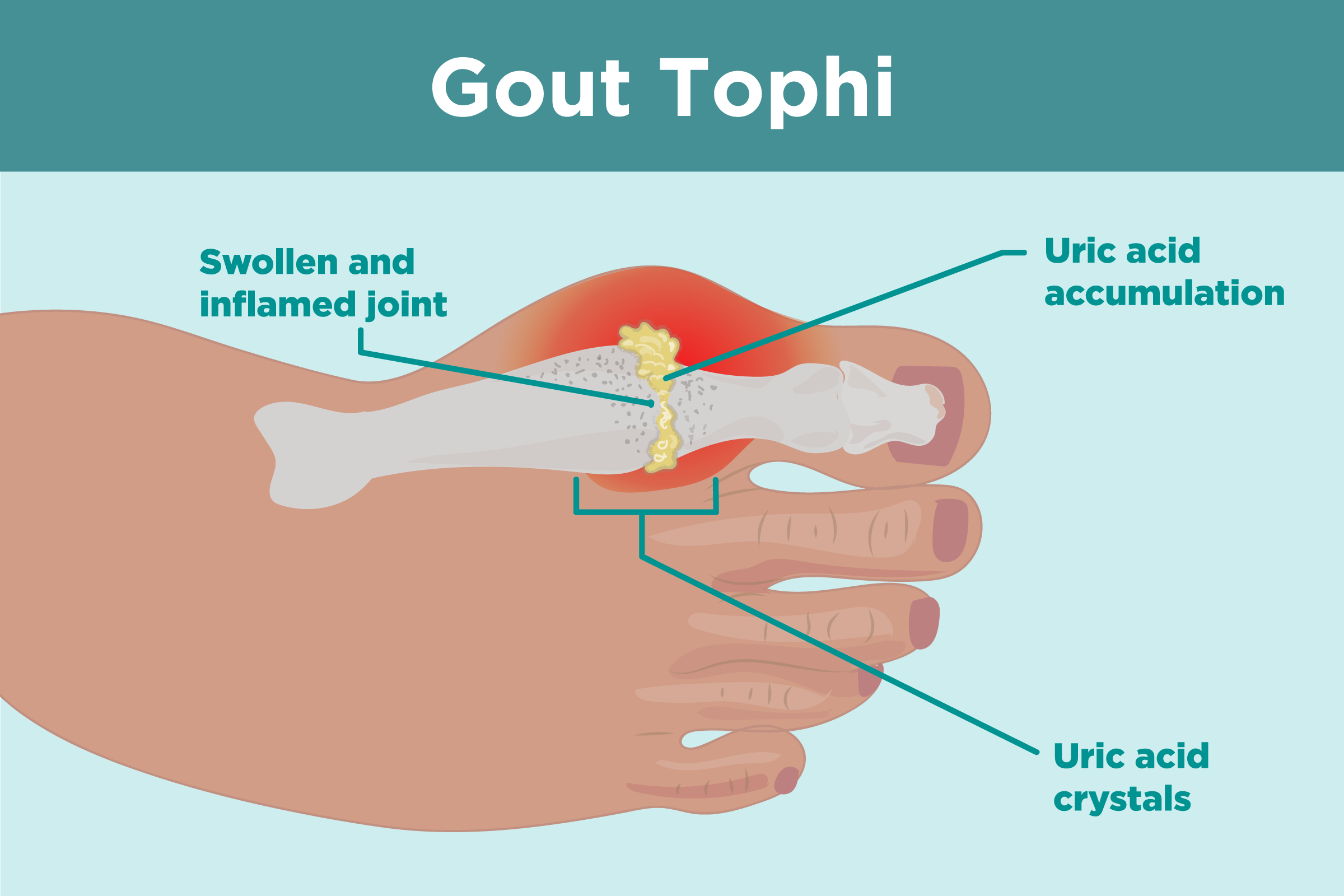 Gout treatment