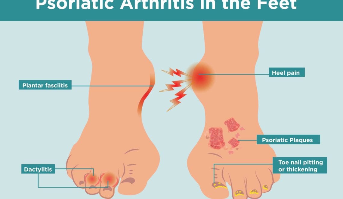 How Psoriatic Arthritis Affects Feet