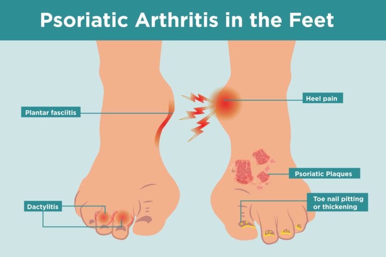 what is the latest treatment for psoriatic arthritis