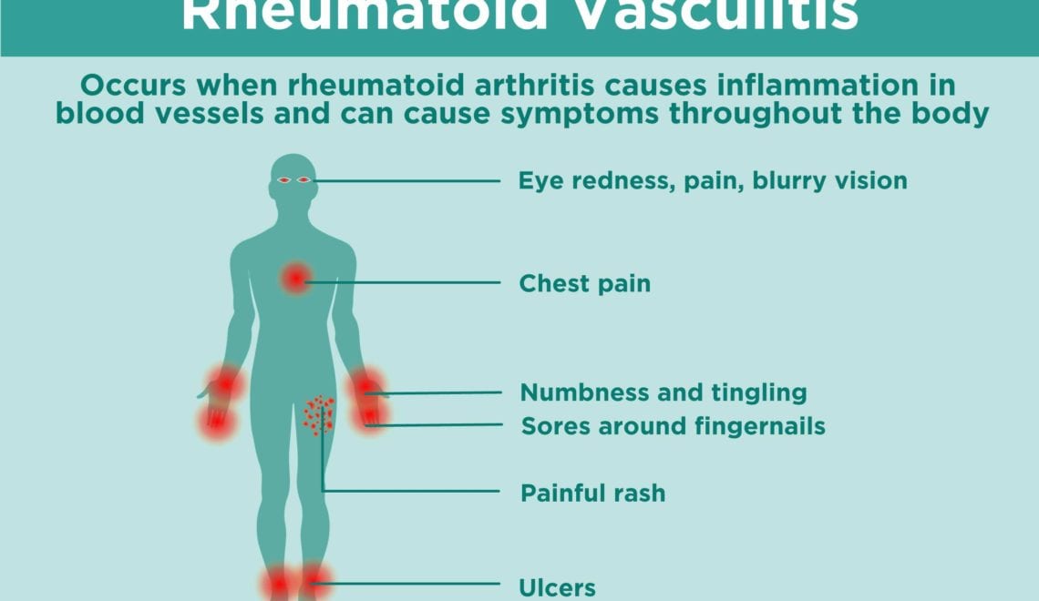 Rheumatoid Vasculitis