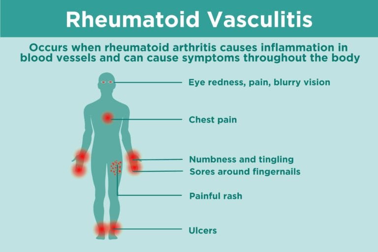 rheumatoid-arthritis-ra-causes-symptoms-treatment-faqs