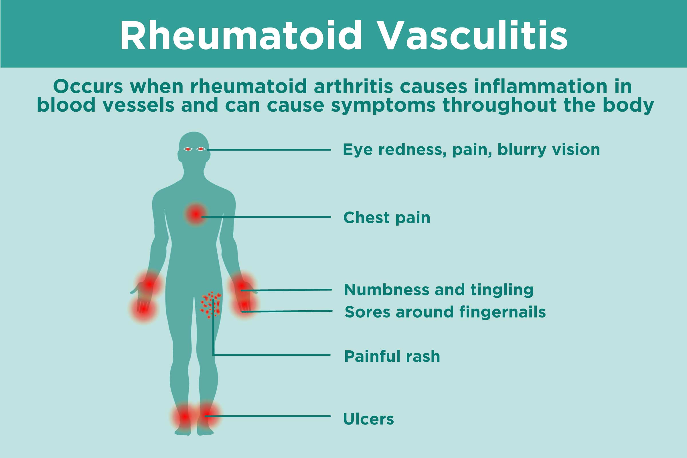 0519 Rheumatoid Vasculitis 