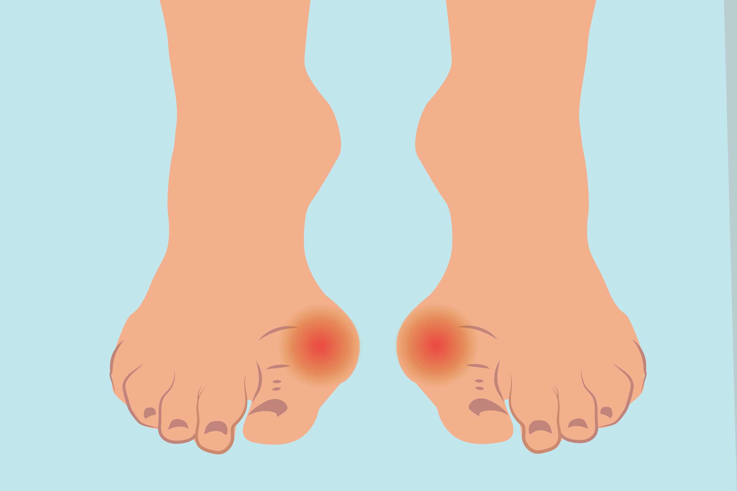 Hammertoe and mallet toe - Symptoms and causes - Mayo Clinic