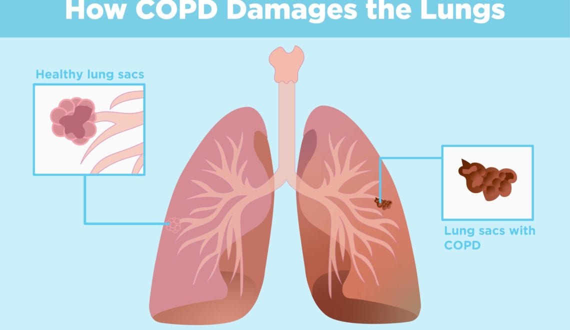 COPD and Arthritis