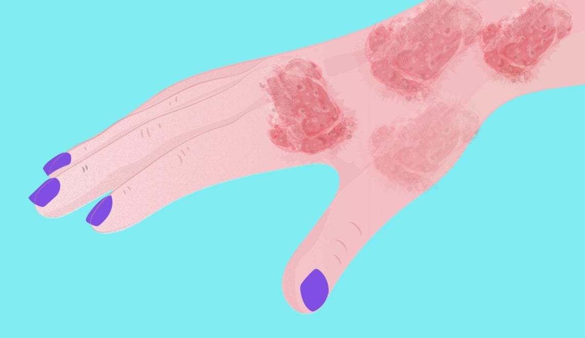 Cartoon shows a hand with red, scabby spots due to psoriatic arthritis