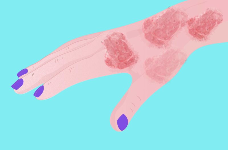 Cartoon shows a hand with red, scabby spots due to psoriatic arthritis