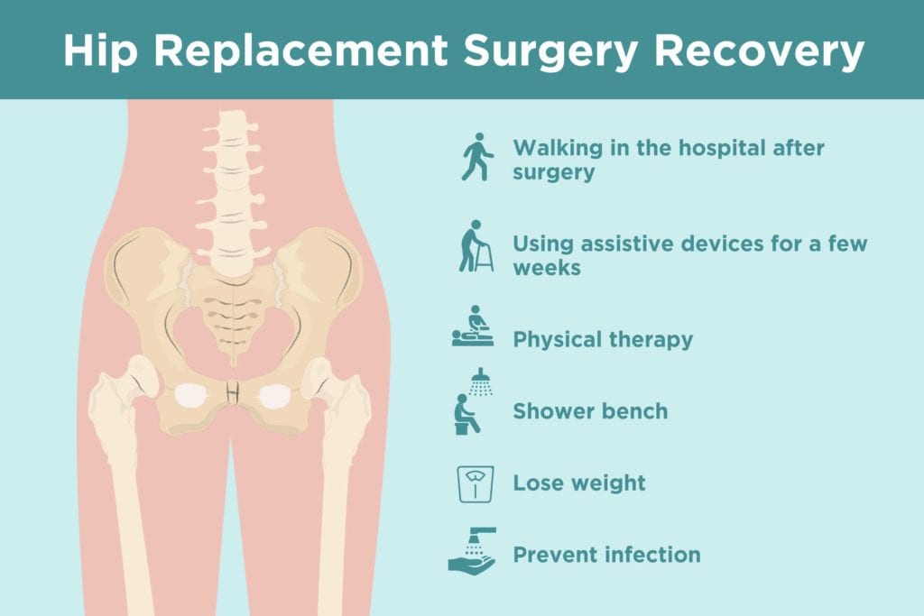 Hip Replacement Recovery Tips From Doctors And Patients 5802