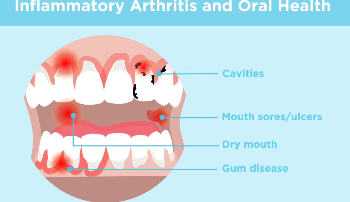 Inflammatory Arthritis and Oral Health