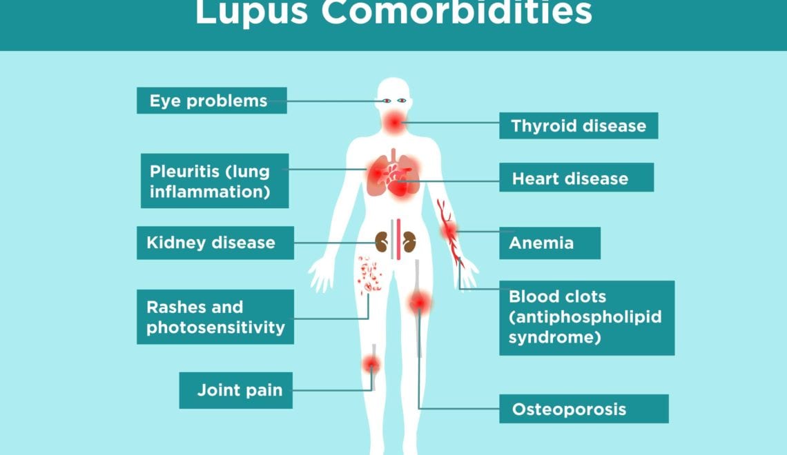 Lupus Comorbidities Infographic