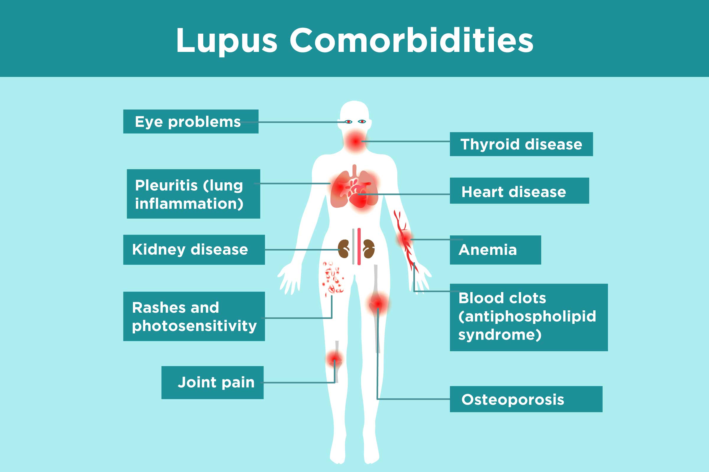 Diagnosing Lupus 