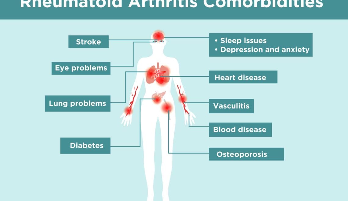 Rheumatoid Arthritis Comorbidities Infographic