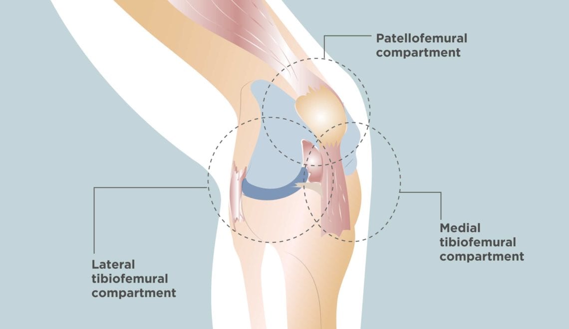 Tricompartmental Knee Osteoarthritis