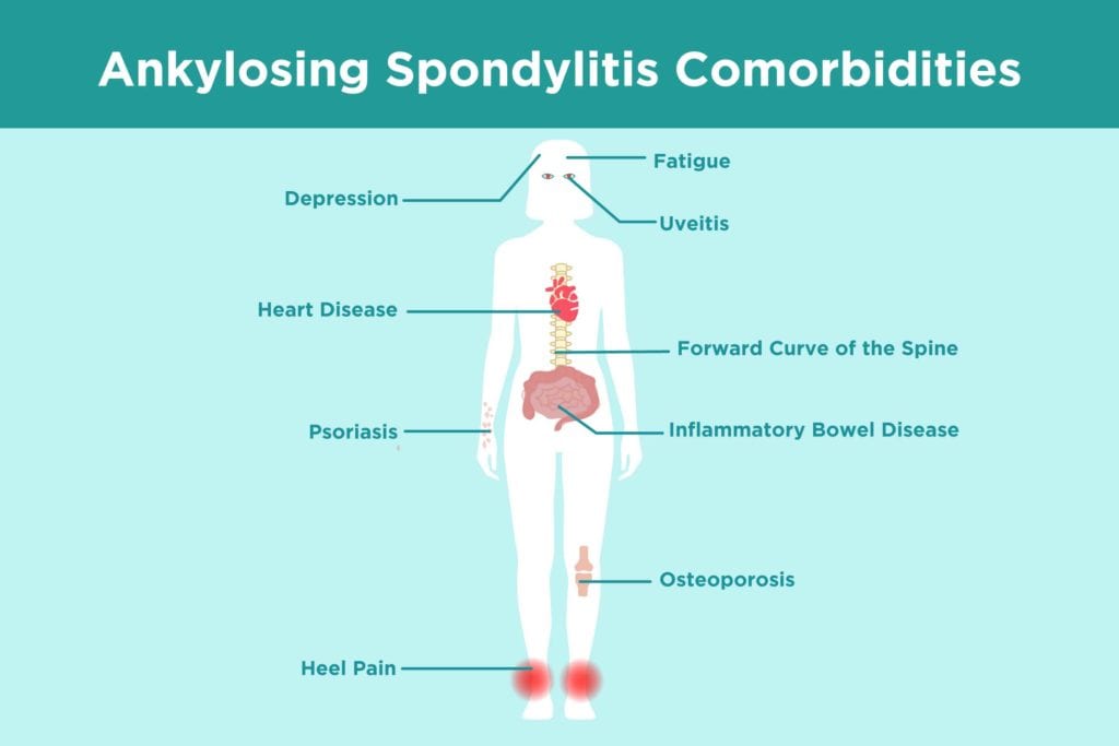 Ankylosing Spondylitis Comorbidities: What AS Patients Need to Know