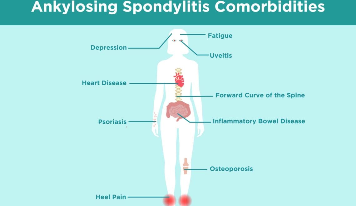 Ankylosing Spondylitis Comorbidities