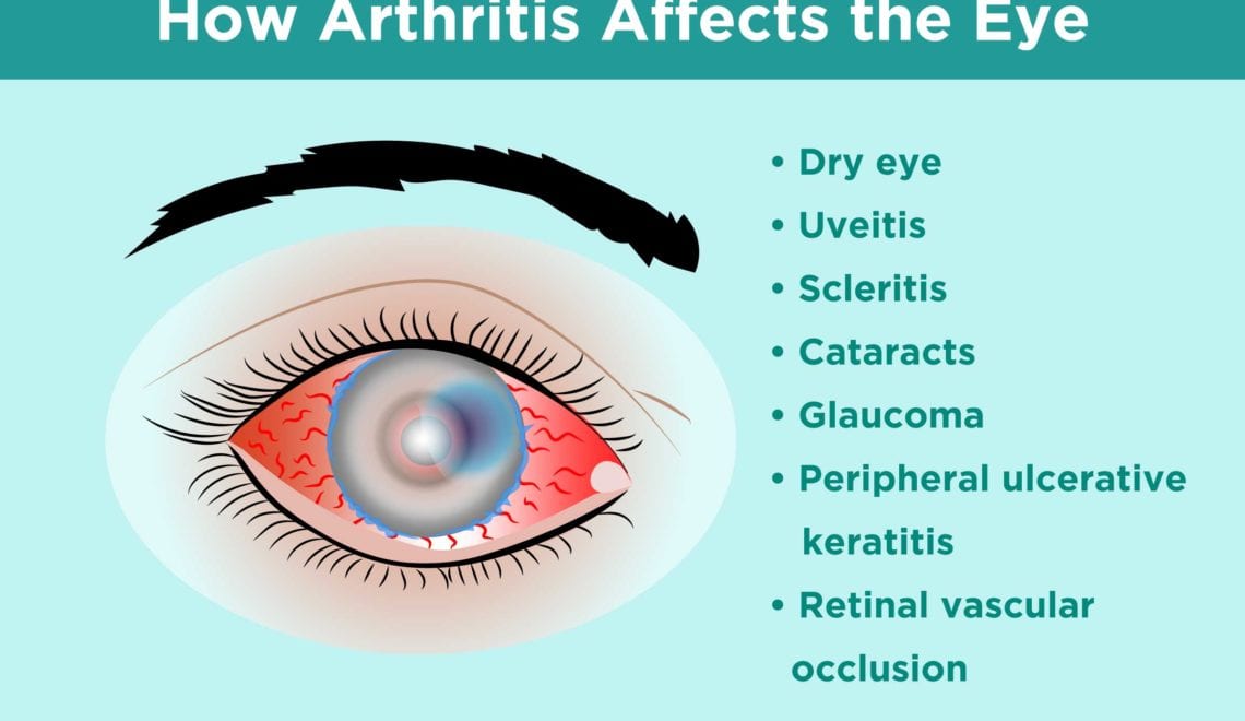 How Arthritis Affects the Eye