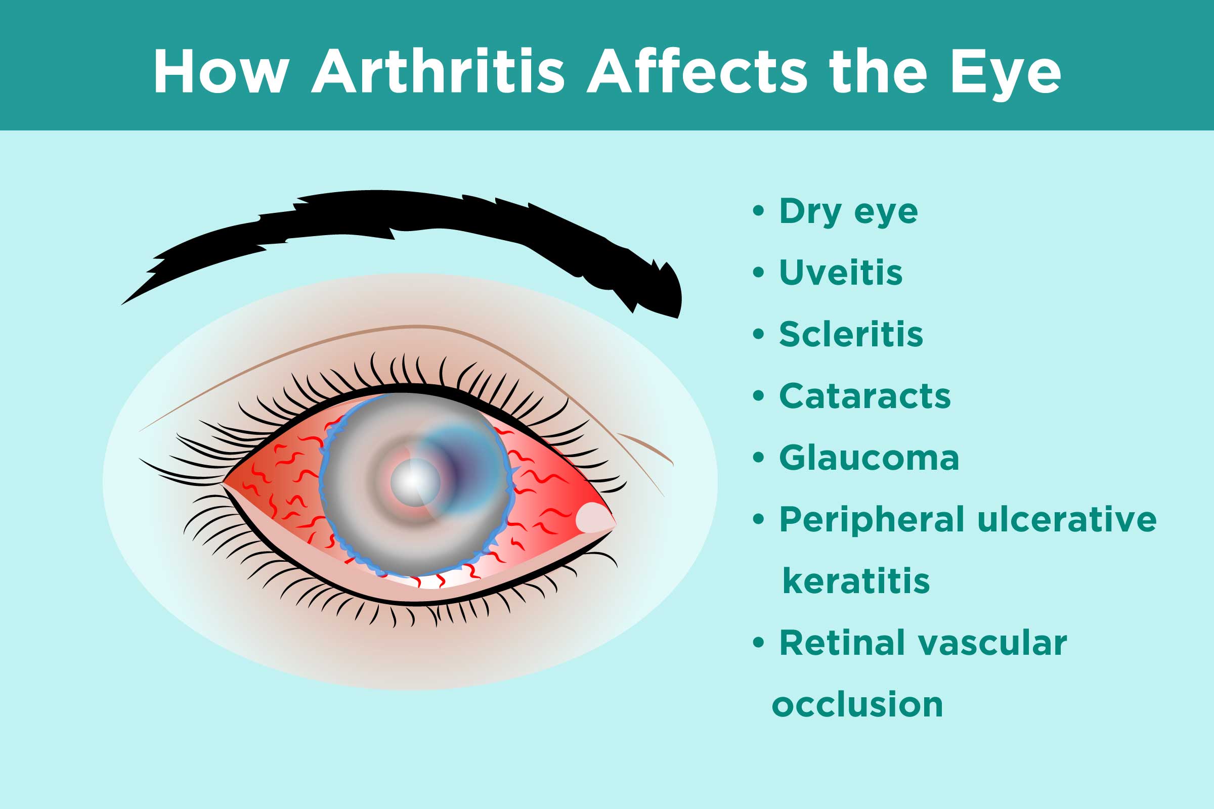 Inflammatory Arthritis And Eye Health Prevention Symptoms Treatment 