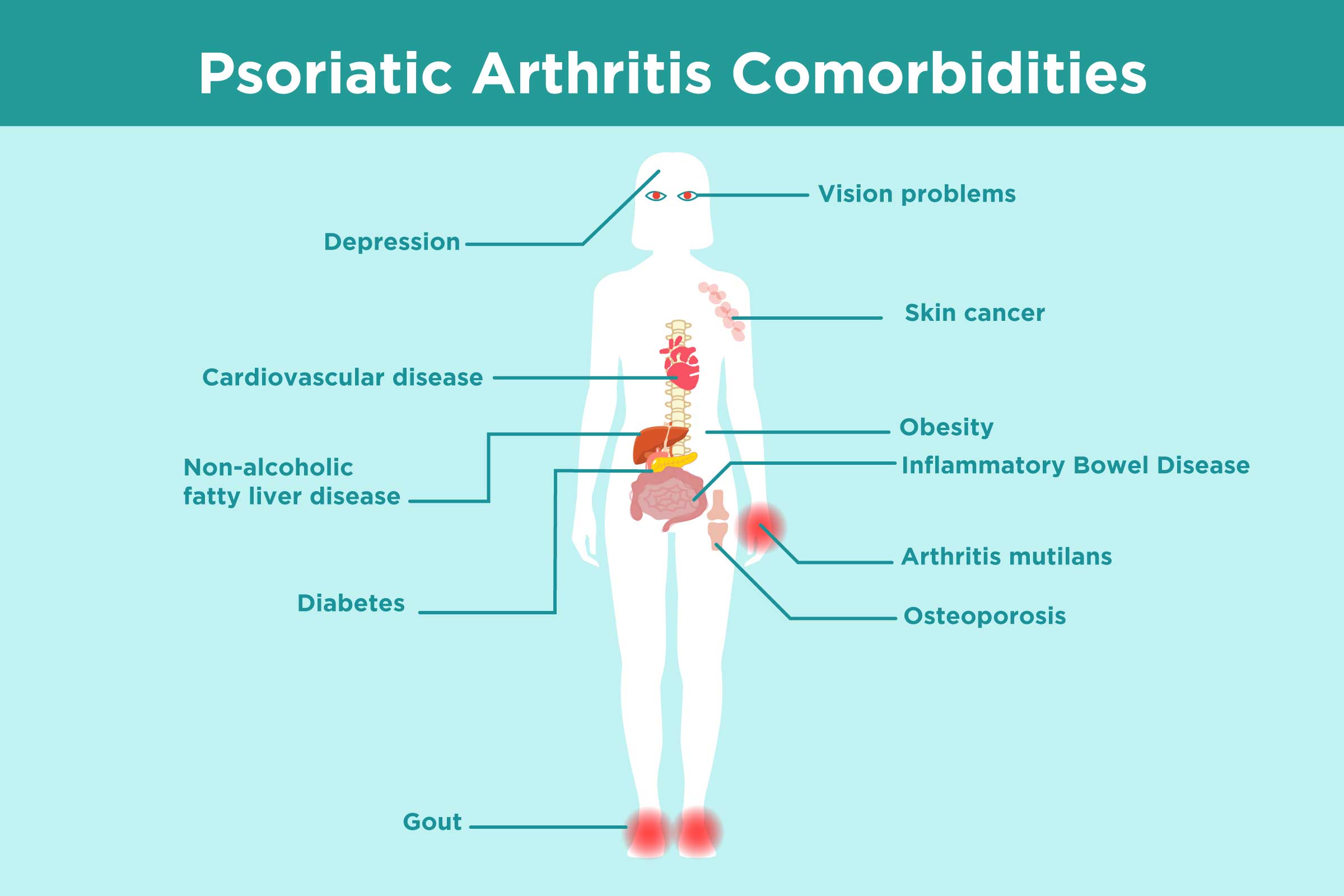 Different Types Of Psoriatic Arthritis: Symptoms,, 49% OFF