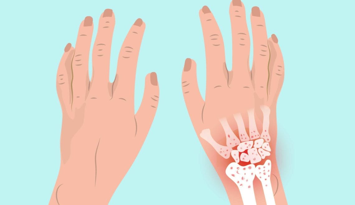 Arthritis in Wrist