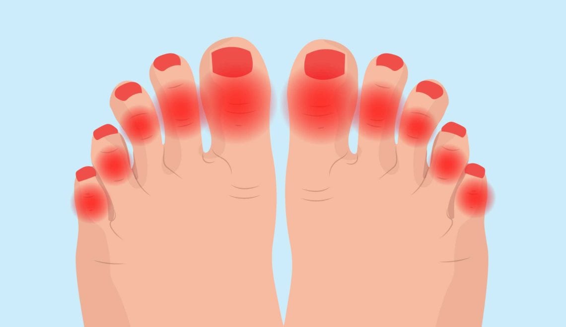Arthritis in Toes
