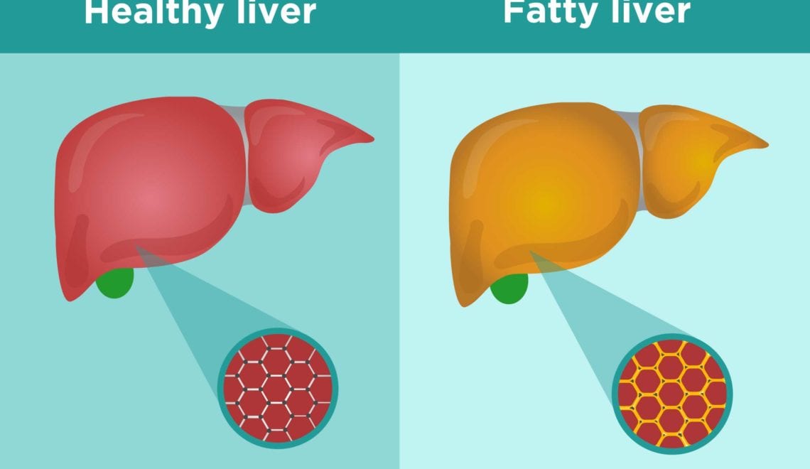 Fatty Liver Disease