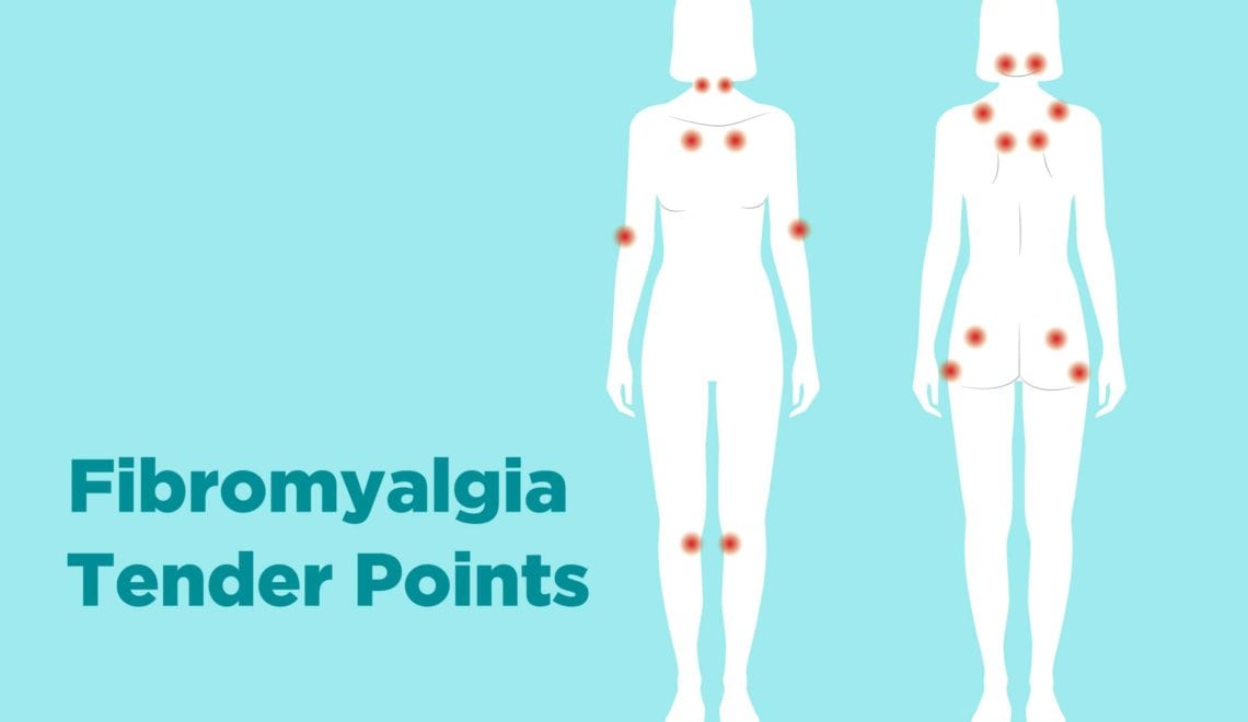 Fibromyalgia Tender Points