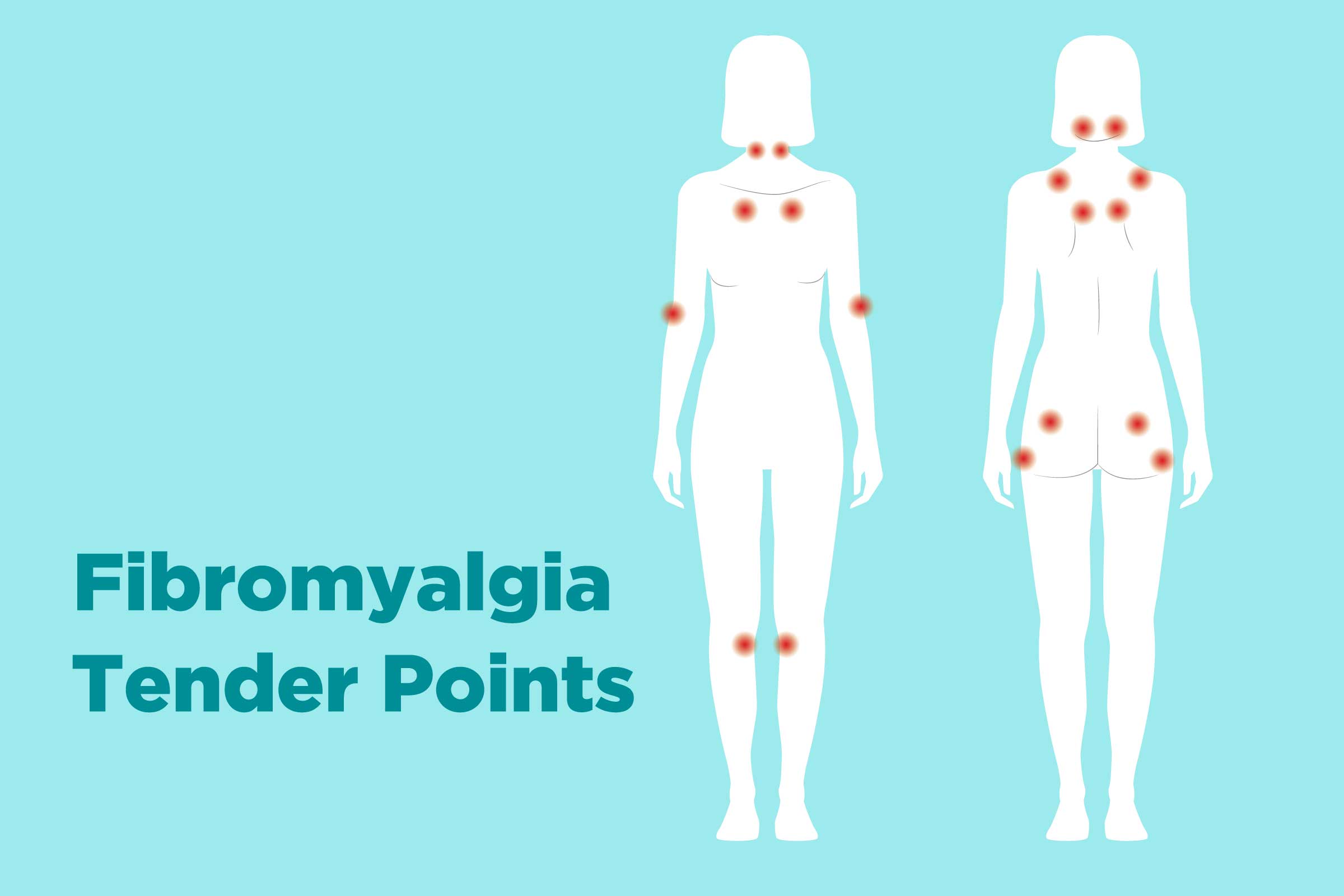 Fibromyalgia Trigger Points Chart