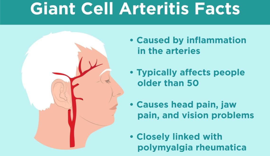 Giant Cell Arteritis Facts