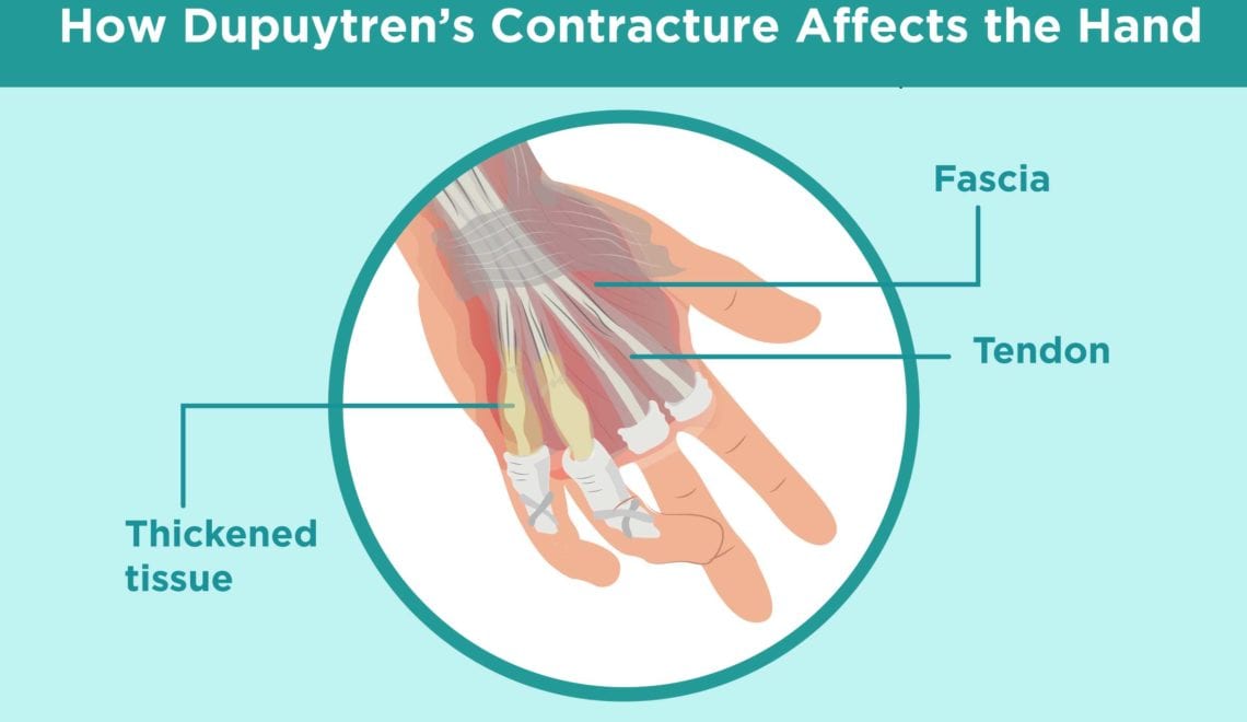 How Dupuytrens Affects the Hand