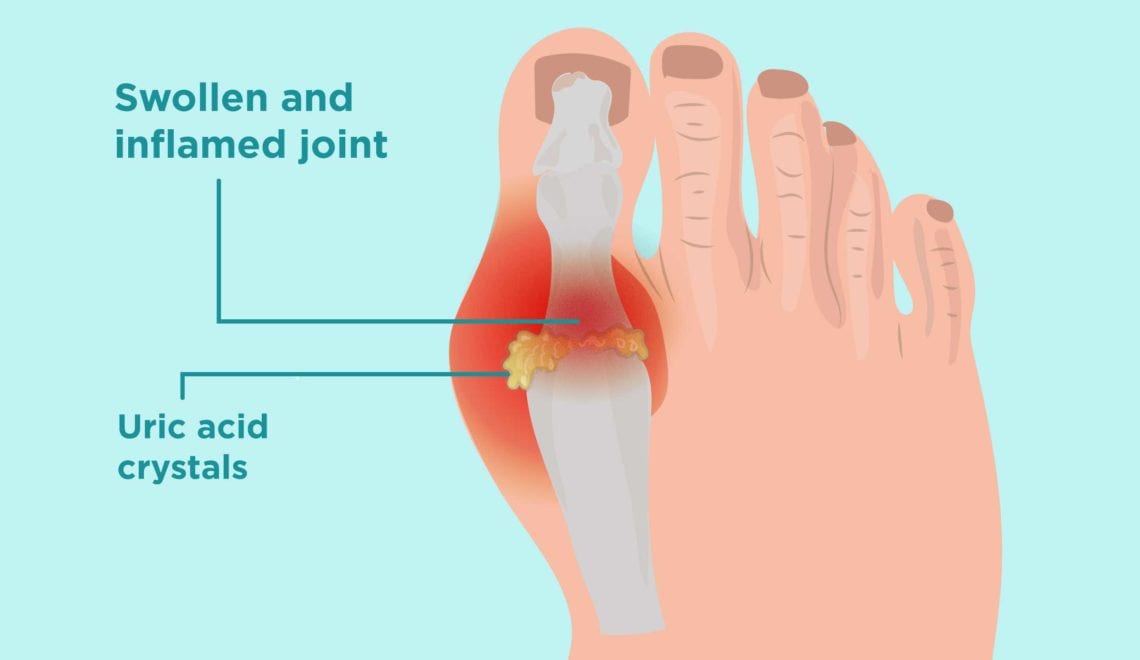 Uric Acid Crystals in Gout