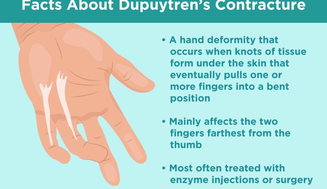 What Is Dupuytren's Contracture